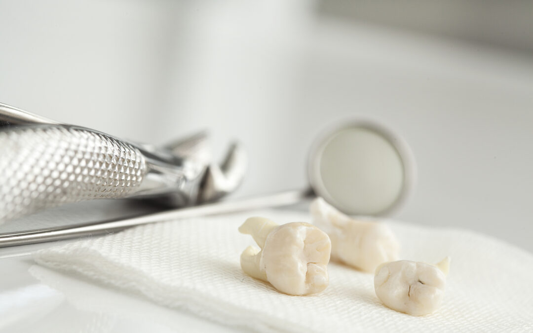 Wisdom Tooth Removal or Childbirth: Which Is More Painful?