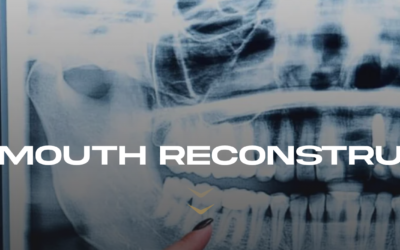 Full Mouth Reconstruction: Who Needs It & Why?