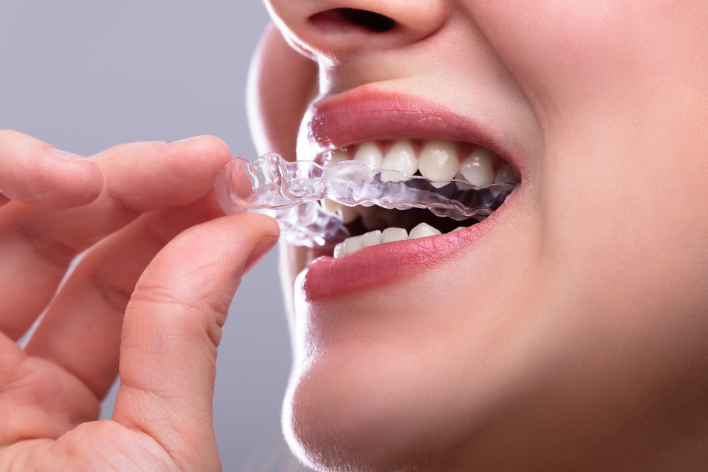 Dental Veneers